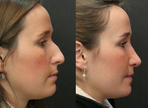 Before and after non-surgical rhinoplasty