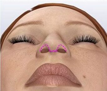 Nose correction