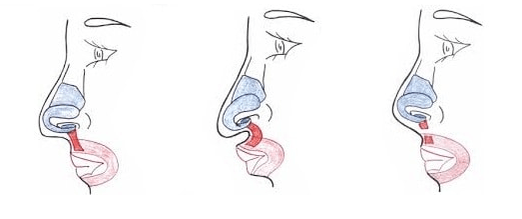 Partial nasal muscle amputation