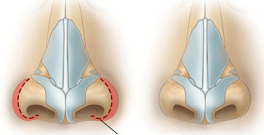 nostril reduction surgery