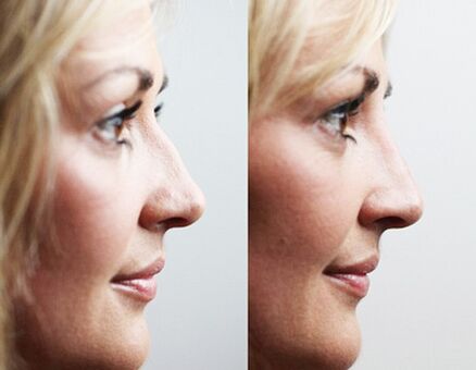 Before and after rhinoplasty with fillers