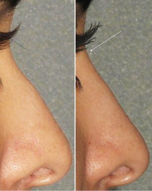 Non-surgical rhinoplasty before and after