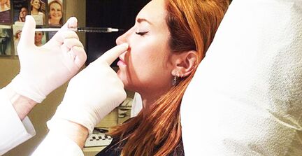 Rhinoplasty using fillers