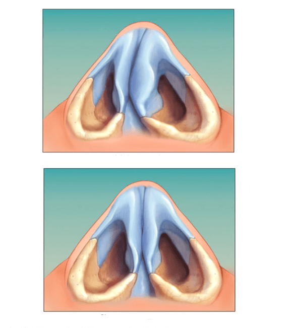 Correction of nasal septum