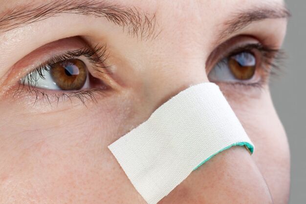 Possible complications after nasal septum correction surgery