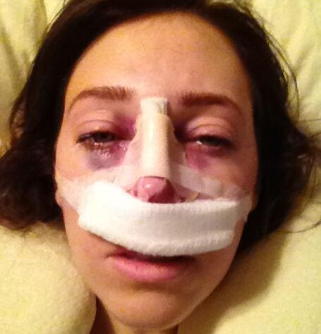 After surgery, the nose is covered with a plaster bandage