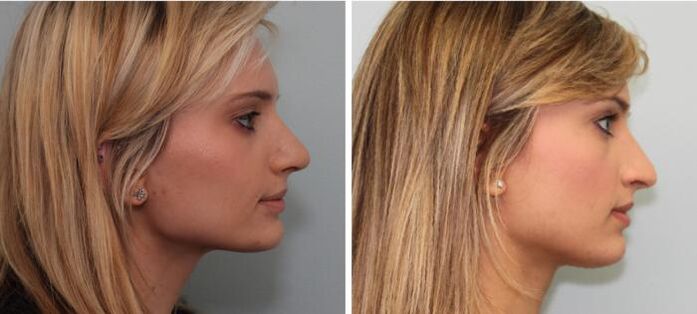 Rhinoplasty surgery before and after results