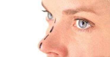 Marking on the nose for inserting makeup thread