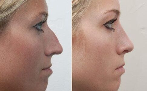 Non-surgical rhinoplasty before and after
