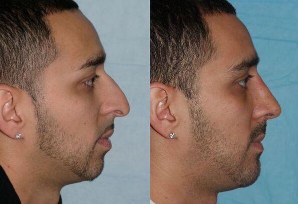 Male nose correction