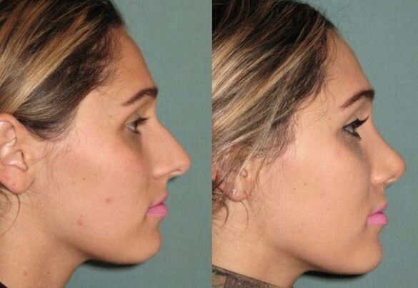 Results of no rhinoplasty injection