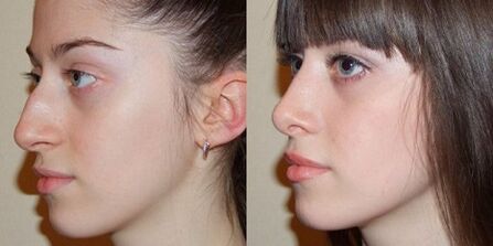Photos before and after rhinoplasty