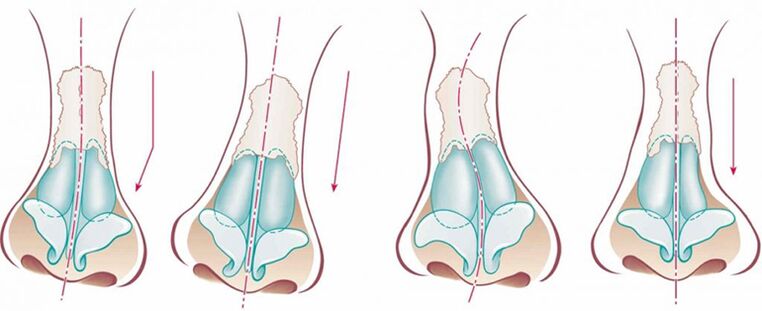 As the curvature of the nasal septum deviates from the linear axis