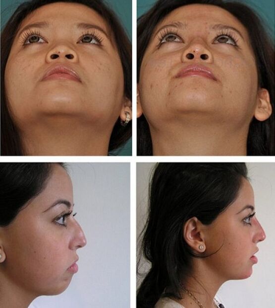 Before and after rhinoplasty without surgery