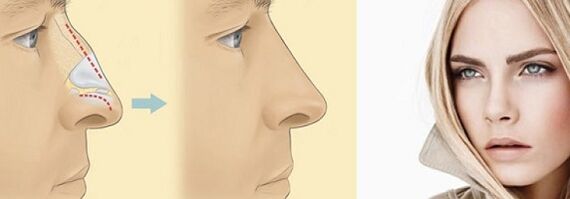 Correct the shape of the nose with non-surgical rhinoplasty