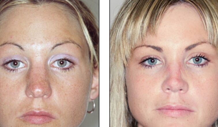 Before and after rhinoplasty surgery failed