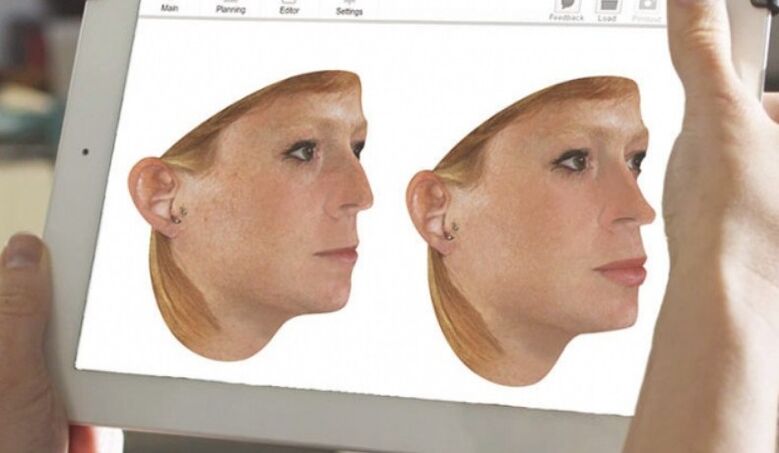 Computer modeling method of nose before rhinoplasty