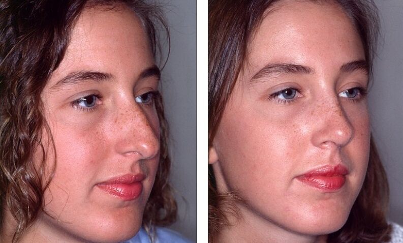 Nose before and after a failed rhinoplasty