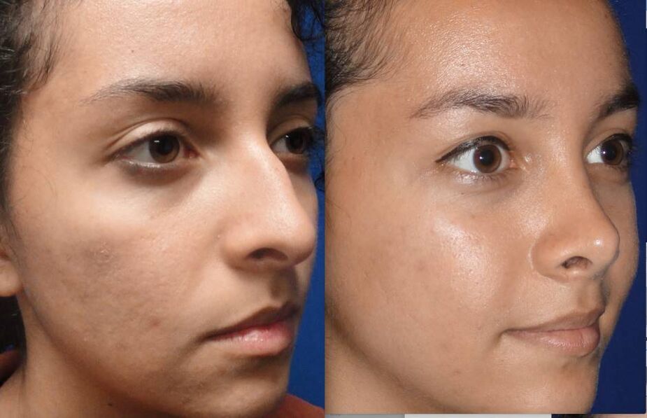 Before and after photo of closed rhinoplasty
