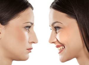 Nose rhinoplasty before and after