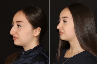 In the direct correction of the nose after rhinoplasty