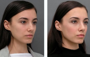 The girl before and after rhinoplasty nose