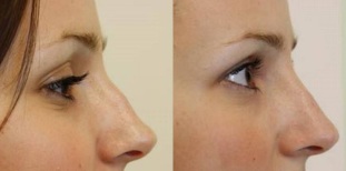 the tip of the nose, before and after