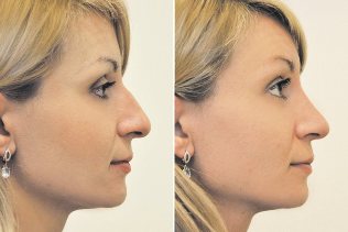 Non-surgical rhinoplasty photos before and after